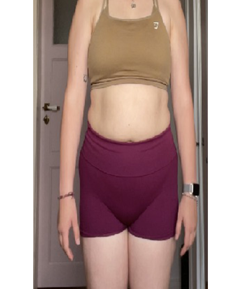 Vorher - Gewichtsreduktion